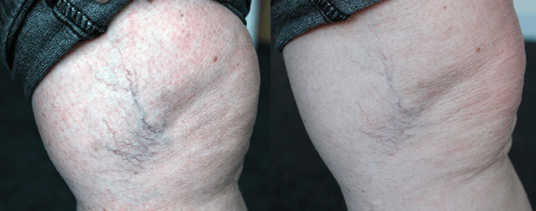 Thread veins – What causes them and is there a way to get rid of them?