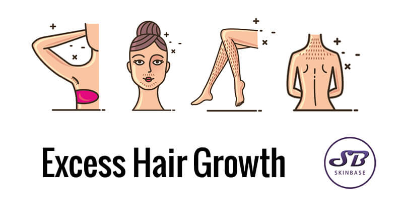 Excess hair growth? Hirsutism, can we treat it?