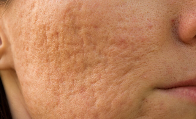 Are we doing enough for acne sufferers?