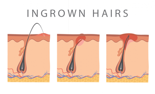 ingrown hairs