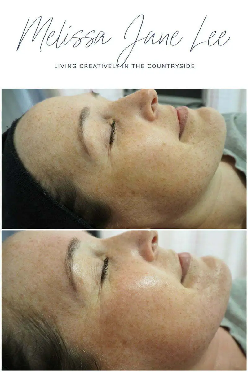 before and after md